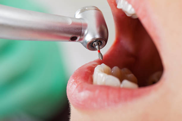 Best Emergency Wisdom Teeth Removal in Kellyville, OK